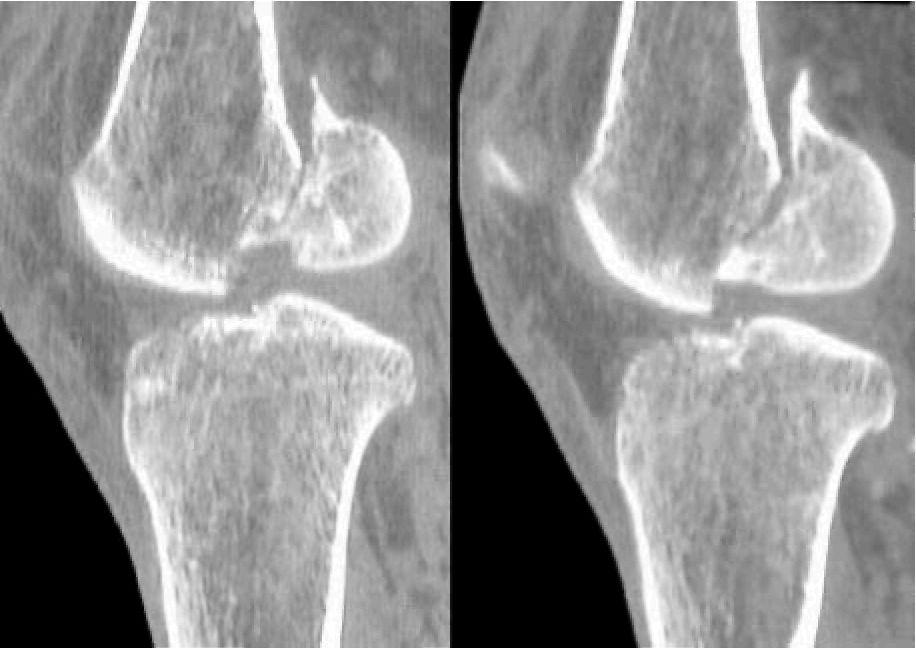 Mehmet S.Binnet, Esin Kayaoğlu. Şekil 7: Hoffa kırığının tomografik görünümü. plağın kullanımında da benzer sorunlar vardır. Her iki implant için de lateralden geniş cerrahi yaklaşım gerekir.