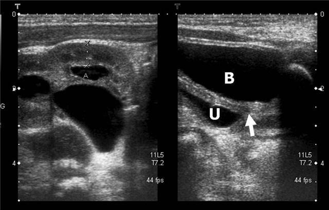 ÜV bileşke darlığı Üreterovezikal bileşke, üreter distal ucu ile mesanenin anatomik olarak birleştiği bölgedir.