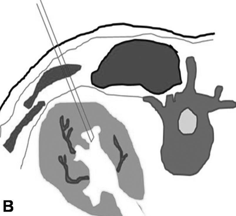 Resim 3. A. Giriş iğnesi sivri trokarı bulunan künt uçlu iğne. B. Lomber kas planların lateralinden, orta hattan yaklaşık 25 derecelik laterale açılanma ile giriş. bir girişim yapılabilir.