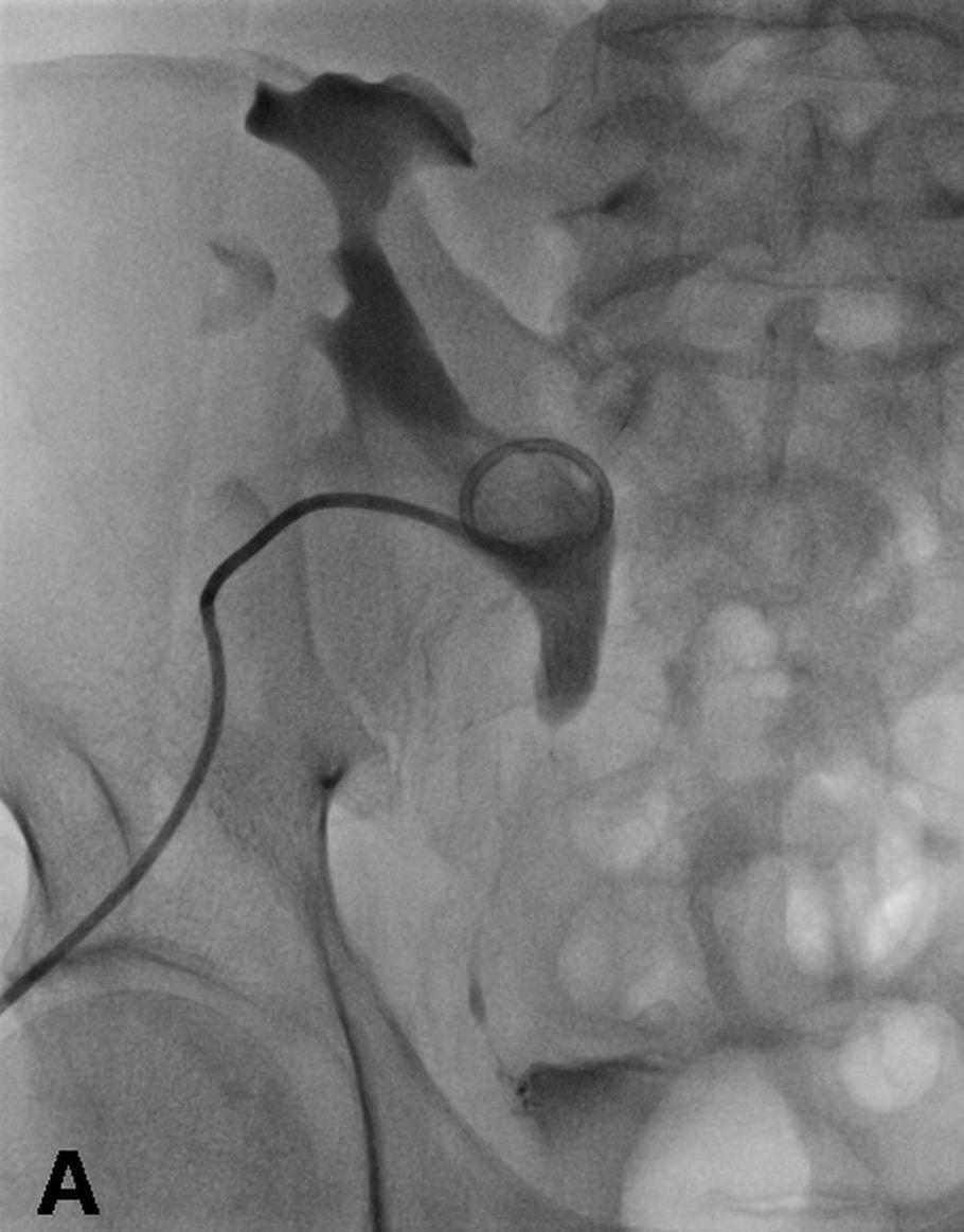 Resim 5. Transplante böbrekte anastamoz darlığı geçilerek Double J üreteral stentin perkütan antegrad yolla yerleştirilmesi. A.