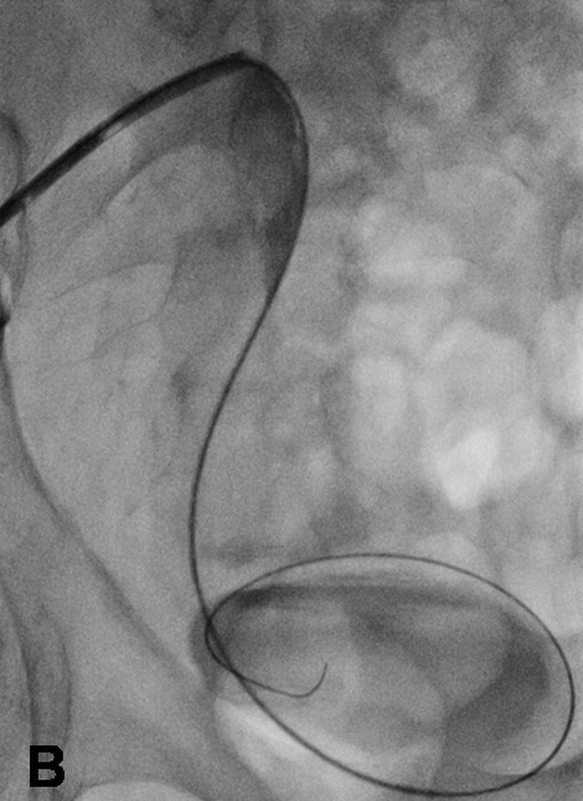 Double J plastik stentin transplante böbrekte uygun pozisyonda yerleştirilmesi. bilme olasılığına karşın, vasküler kılıf çekilmeden bu trakttan nefrostomi kateteri yerleştirilebilir.