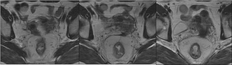 1. Sagittal T2A ardışık MR görüntüleri Orta rektumda duvar kalınlaşması izleniyor.