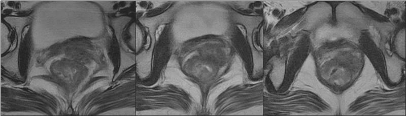 tümöral kitle, anteriorda vajen arka duvarı ile devamlılık halindedir (ok). Resim 5.2.