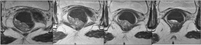 Sagittal T2A ardışık MR görüntüleri Distal rektum posterior duvarda