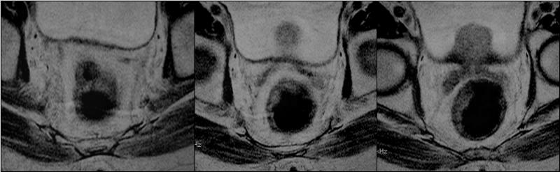 Sagittal T2A ardışık MR görüntüleri Proksimal rektumda duvar kalınlaşması (oklar). Resim 5.