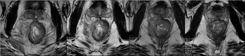 Tümör düzeyinden geçen aksiyel T2A ardışık MR görüntüleri Rektum duvarında çepeçevre ödemli görünüm ile birlikte sağ yan duvarda müsküler