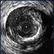 Stent sonrası