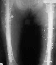 Ameliyat öncesi dönemde hastalara tüberositas tibiadan Steinman teli ve Braun-Böhler ateli ile iskelet traksiyonu uyguland.