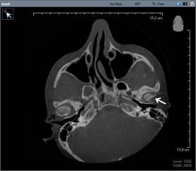 Hastanın sağ lateral volumetrik (3-D) görüntüsü.