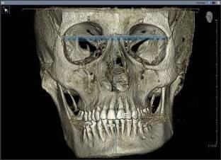 Panoramik radyografta sağ mandibular korpus ve kondil bölgesinde asimetri gözlendi, fakat kondil başı ve glenoid fossa bölgeleri net olarak görüntülenemedi.