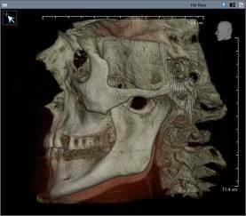 Resim 5.B. Hastanın sol lateral volumetrik görüntüsü. Resim 6.A.
