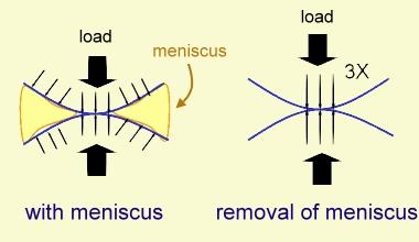 Menisküsler kaldırıldığında; Tibial platonun kartilajında streslerin