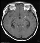 Mucormycosis SSS