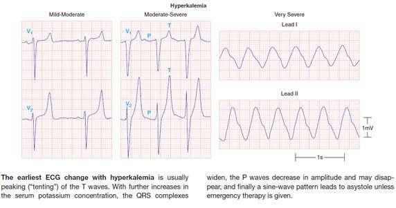 Hiperkaleminin kardiyak etkileri EKG değişiklikleri EKG değişklikleri hassas değil *Bir