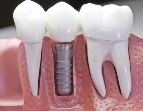 İmplant operasyonları implant başına yaklaşık 10-20 dakika sürmektedir. Diş ve kemik yapısına göre bu süre değişebilir.