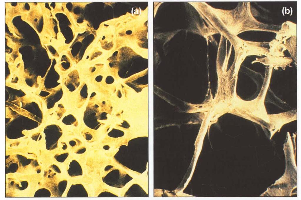 Osteoporoz Patogenezi