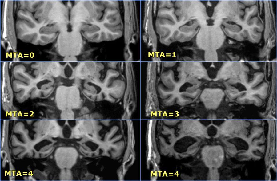 Medial temporal lob atrofisi 75 yaşından küçüklerde skor