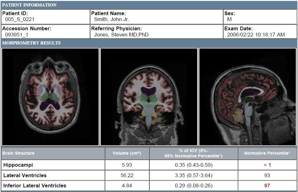 Volumetric MRI Analiz- NeuroQuant