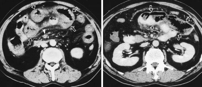 Abdominal BT De 2.