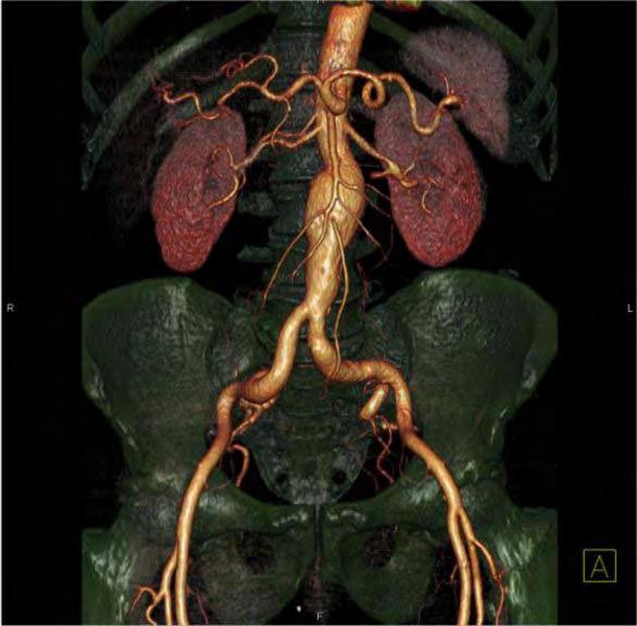 Abdominal BT De 1.