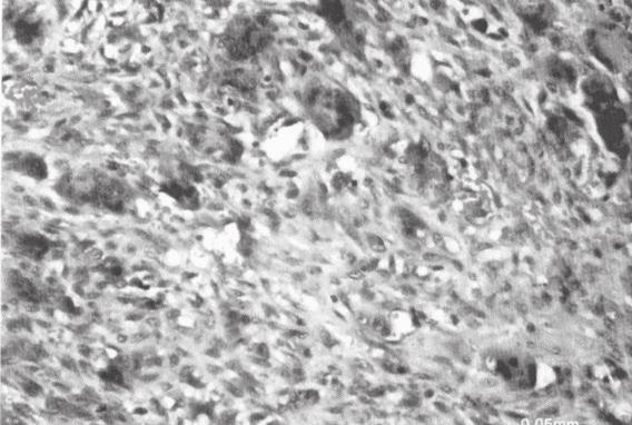 53 KAYNAKLAR RESİM 7 Lezyonun histopatolojisi (bar=0.05 mm) oluşurken diğerleri küçük piknotik çekirdekten oluşmaktadır 8. PDHG deki dev hücrelerin kaynağı hala kanıtlanmamıştır 15.