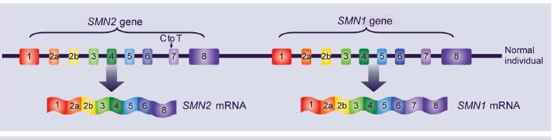 SMN2 genin ekzon 7 kolunda C den T dönüşümü gerçekleşmiştir.