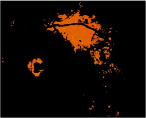 , "Computer Based Detection of Diabetes Retinopathy Stages Using