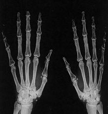 224 Acta Orthop Traumatol Turc 1960 larda salt trapezium eksizyonuna alternatif olarak prostetik implantlarla veya fasya, tendon yap - larla interpozisyon öne sürülmüfltür.