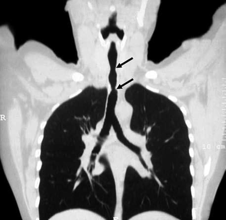 bilgisayarlı tomografi görüntüsü izlenmekte. Uç-uca anastomoz sırasında, hastanın distal trakeadan havalandırılmaya devam etme zorunluluğu, anastomoz dikişlerinin geçişini güçleştirmektedir.