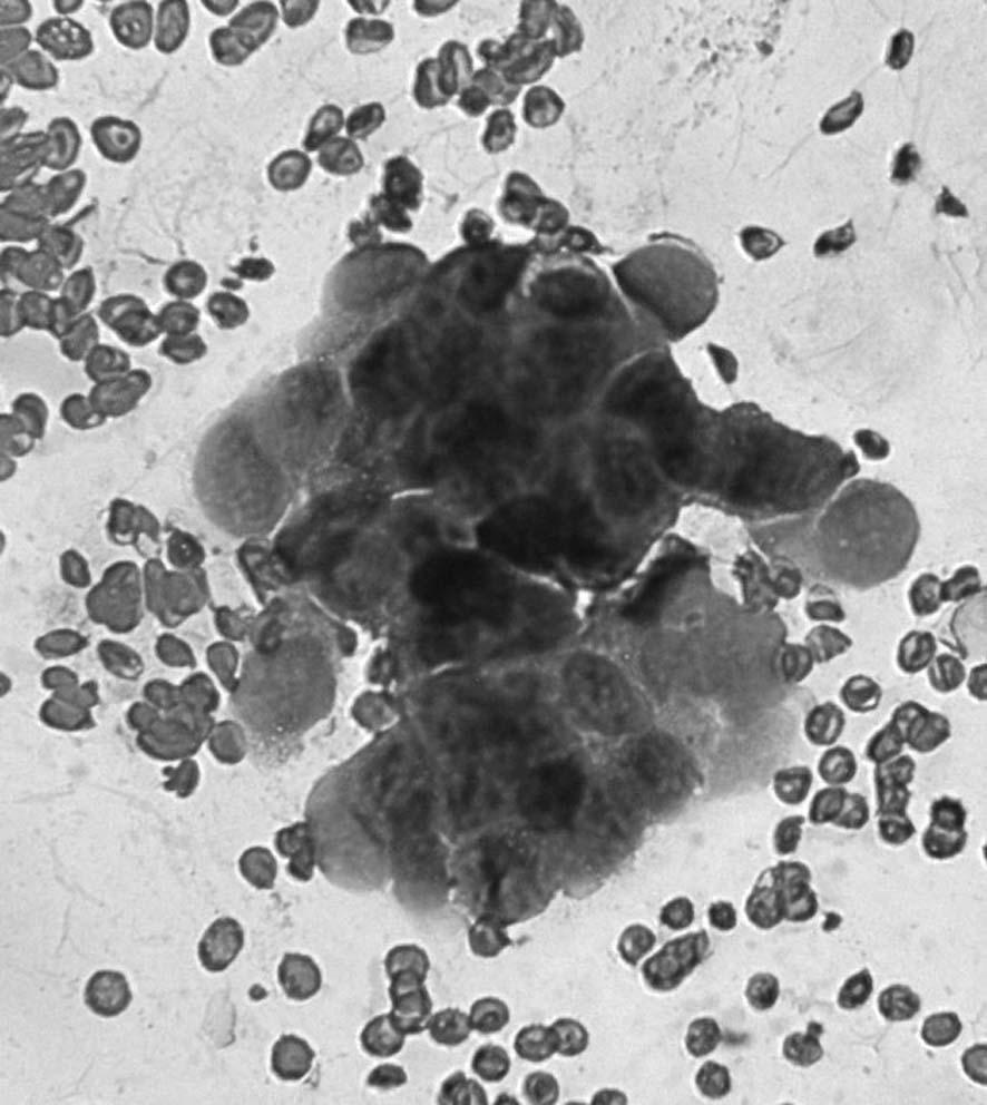 Baz lar nda nükleomegali, hiperkromazi ve pleomorfizm izlenen epitelyal hücreler. Sitolojik olarak malignite aç s ndan flüpheli tan s alan olguya ait yayma ( f rça sitolojisi, HE).