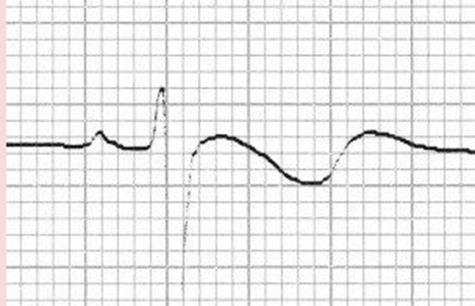 EKG çekilirken asemptomatik.