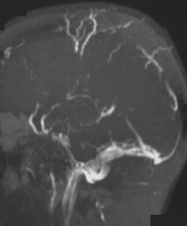 PNH de Tromboz Vücutta Herhangi Bir Bölgede Görülebilir Sık etkilenen bölgeler arasında intra-abdominal ve serebral venler de bulunur1 Hepatik ven (Budd-Chiari sendromu) tutulumu hastaların %7.