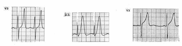 Miyokard İnfarktüsünde nde EKG İpuçları Amaçlar Miyokard infarküsünde (Mİ) EKG değişim süreçlerini öğrenmek Ayırıcı tanıları yapmak Spesififik patolojilerde EKG ile Mİ yi tanımak Dr.