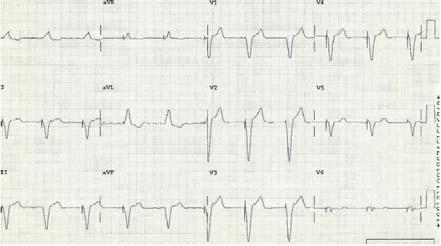 depresyonu > 1 mm o Duy: %29 Seç: %82 Maloy KR, Bhat R, Davis J, et al. Sgarbossa Criteria are Highly Specific for Acute Myocardial Infarction with Pacemakers. West J Emerg Med.