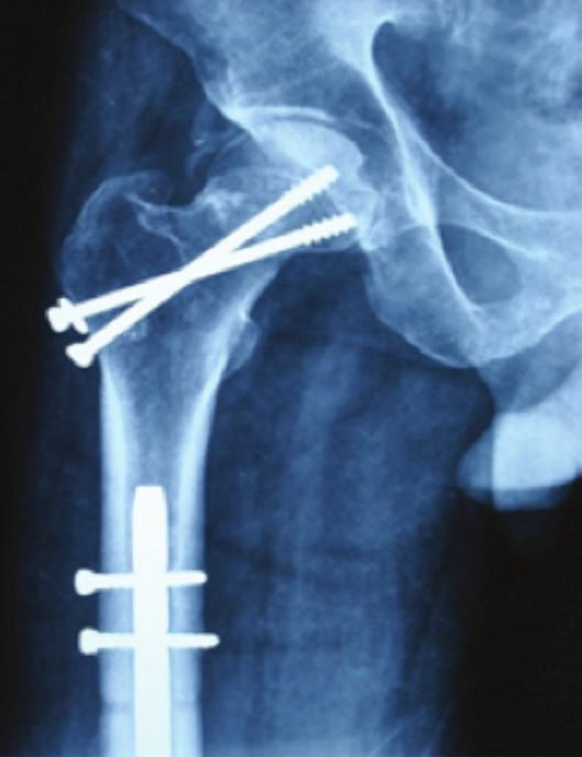 yılda kalçada avasküler nekroz veya osteoartrit bulgusu olmaksızın tüm kırıkların iyileştiğini gösteren sağ kalça ve femurun ön-arka grafileri. Kalça çevresinde heterotopik ossifikasyon görülmektedir.