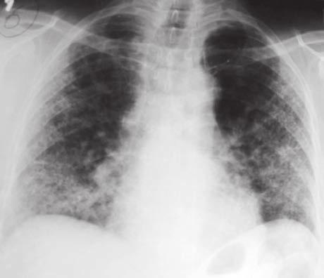8 İNTERSTİSYEL AKCİĞER HASTALIKLARI İnterstisyel akciğer hastalıklarının yaygınlığı ve görülme sıklığı çok net bilinmemektedir, çünkü bu hastalıklarla ilgili epidemiyolojik çalışmalar sınırlıdır.