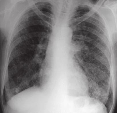 İnterstisyel akciğer hastalıklarının çok geniş bir grup olmasına karşın bazı ortak özellikleri vardır. Bu grup hastalar genellikle ilerleyici efor dispnesi ve kuru öksürük ile başvurur.