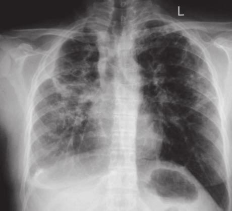 Bilgisayarlı tomografide (BT) lezyonlar direkt grafiye göre daha ayrıntılı görülür.