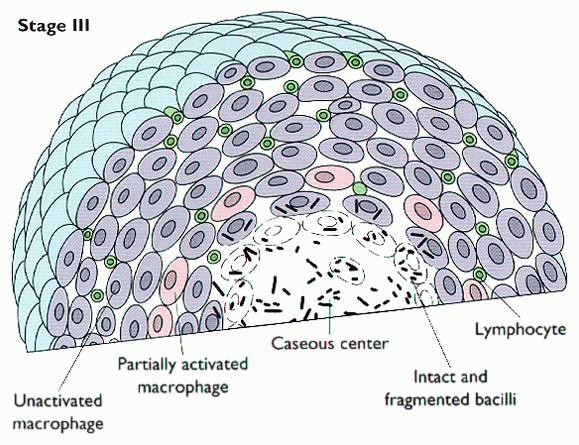 Evre III (CMI- DTH ) 3. haftadan sonra hücresel immün yanıt ve aşırı duyarlılık başlar. Makrofaj ve lenfositler nekroz ve basilin etrafını sarar.
