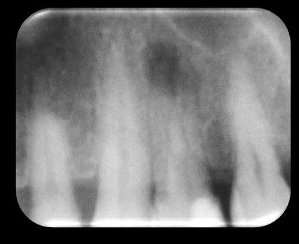 Resim 4.3. Rezin esaslı kanal dolgu patı ve tek kon yöntemi ile tek seansta endodontik tedavisi tamamlanmış sol üst birinci küçük azı dişinin başlangıç ve son takip radyografları Tablo 4.5.
