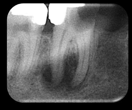 seansta yapılmış tek kon yöntemi uygulanan dişler için farklı kanal dolgu patları ile endodontik başarı arasında anlamlı düzeyde bağıntı yoktur (Pearson Ki- Kare=2.