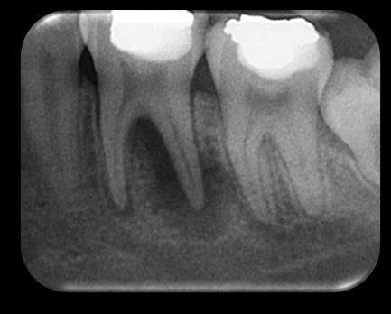 ve endodontik tedavinin sonuçlarının değerlendirilmesi Tek kon yöntemi ve rezin esaslı pat kullanılan 162 dişin 148 inin(%91.4) tedavisi PAİ 1 veya 2 skoru alırken, 14 diş (%8.