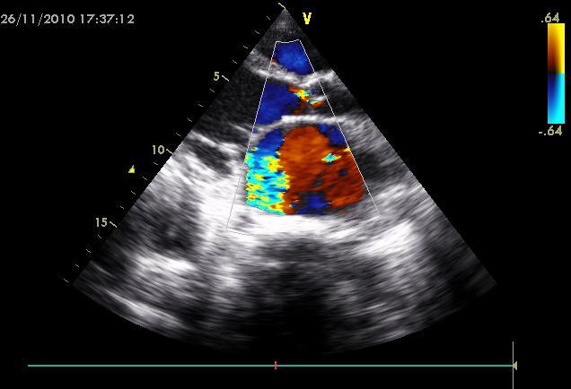 Aort yetmezliğinin ciddiyetinin derecelendirilmesi için Renkli Doppler ekokardiyografi ile uzun eksen pozisyonunda jet genişliği ölçüldü ve sol ventrikül çıkış yolu genişliğine bölündü