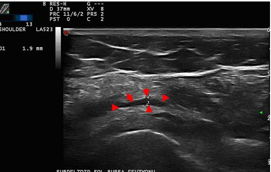 supraspinatus tendonu (beyaz ok). Şekil 17.