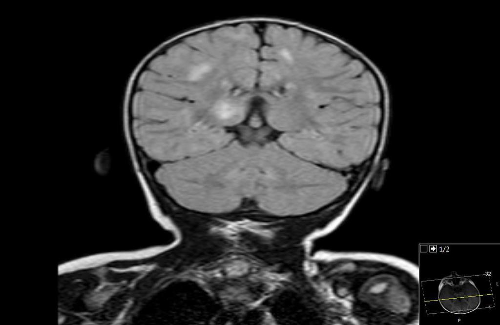 KRANİAL MR Koronal FLAIR görüntüde bilateral subkortikal ak maddede ve sağ