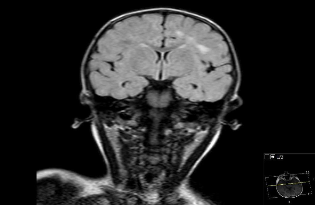 KRANİAL MR Koronal FLAIR görüntüde sol hemisferdel subkortikal ak maddede