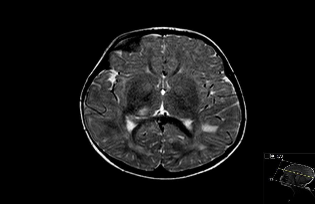 KRANİAL MR Aksiyel T2-ağırlıklı görüntüde bilateral subkortikal ak maddede ve sağ