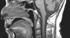 T1A sagital ve T2A aksiyel görüntülerde ventriküler sistem ve
