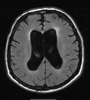 Aksiyel FLAIR MRG kesitinde (B) ventriküler sistemde genişleme ve frontal periventriküler beyaz cevherde iskemik,