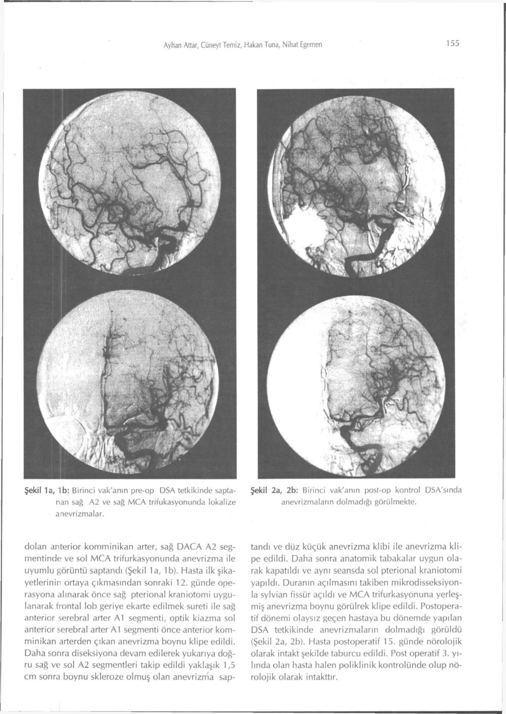 Ayhan Attar, Cüneyt Temiz, Hakan Tuna, Nihat Egemen 155 Şekil 1a, 1b: Birinci vak'anın pre-op DSA tetkikinde sapta- Şekil 2a, 2b: Birinci vak'anın post-op kontrol DSA'sında nan sağ A2 ve sağ MCA